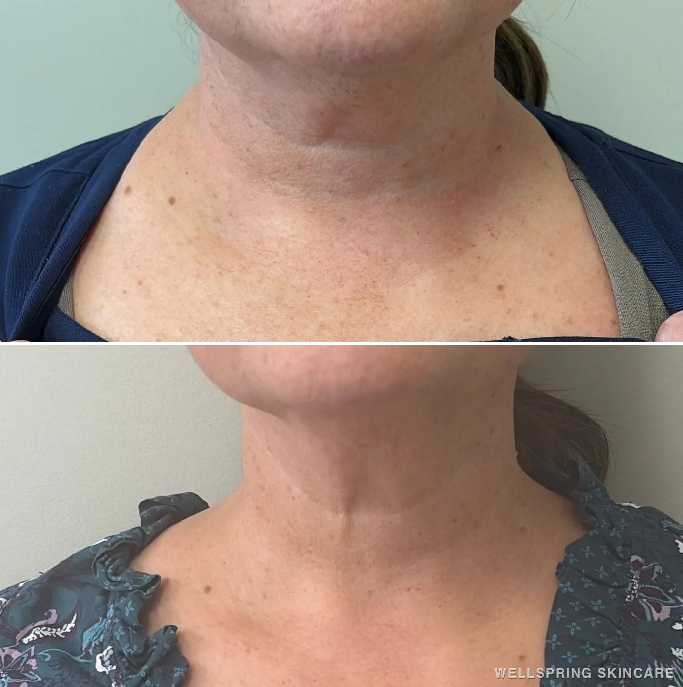 Before and after: Neck bands softened with Botox