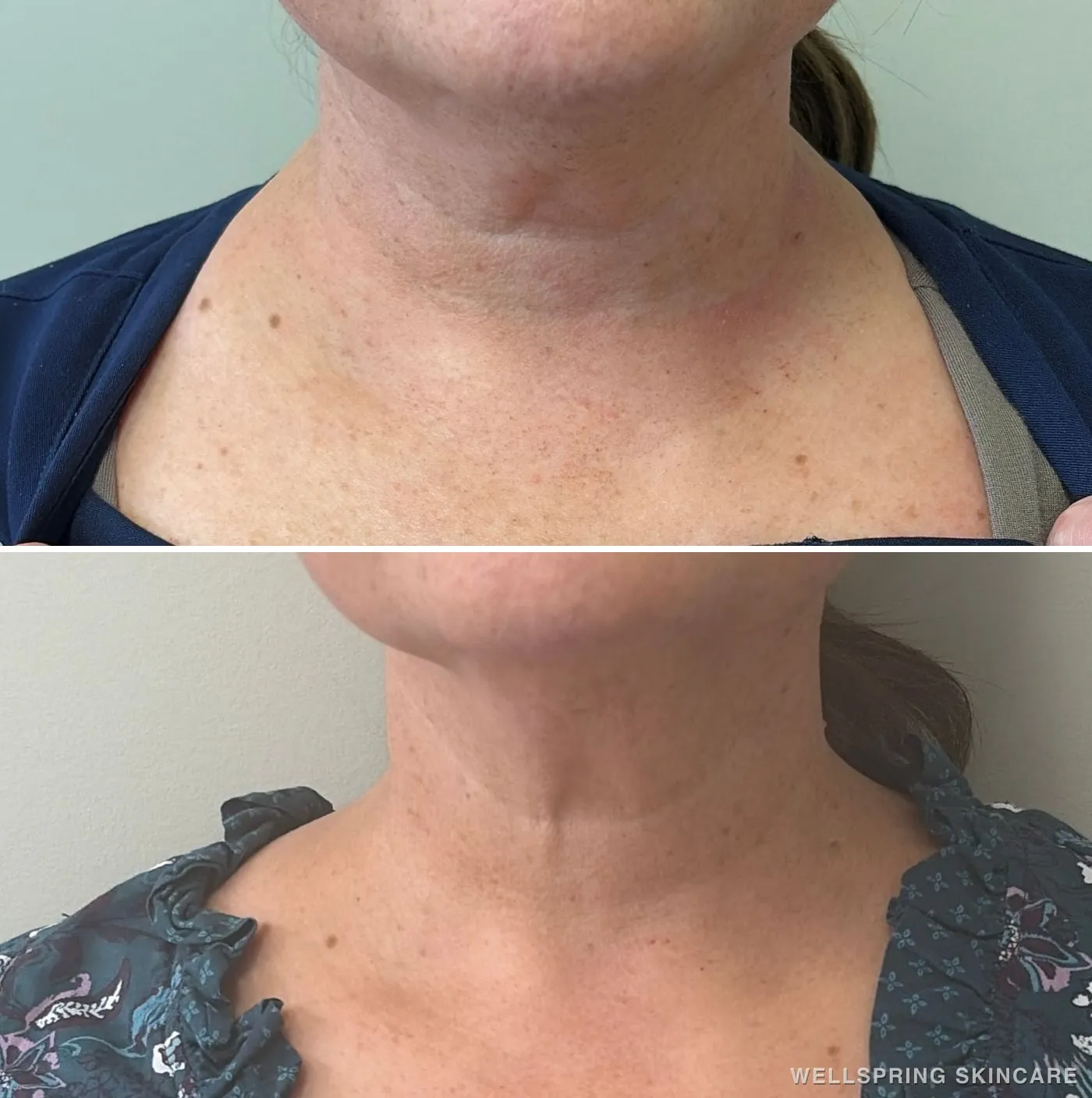 Before and after: Neck bands softened with Botox