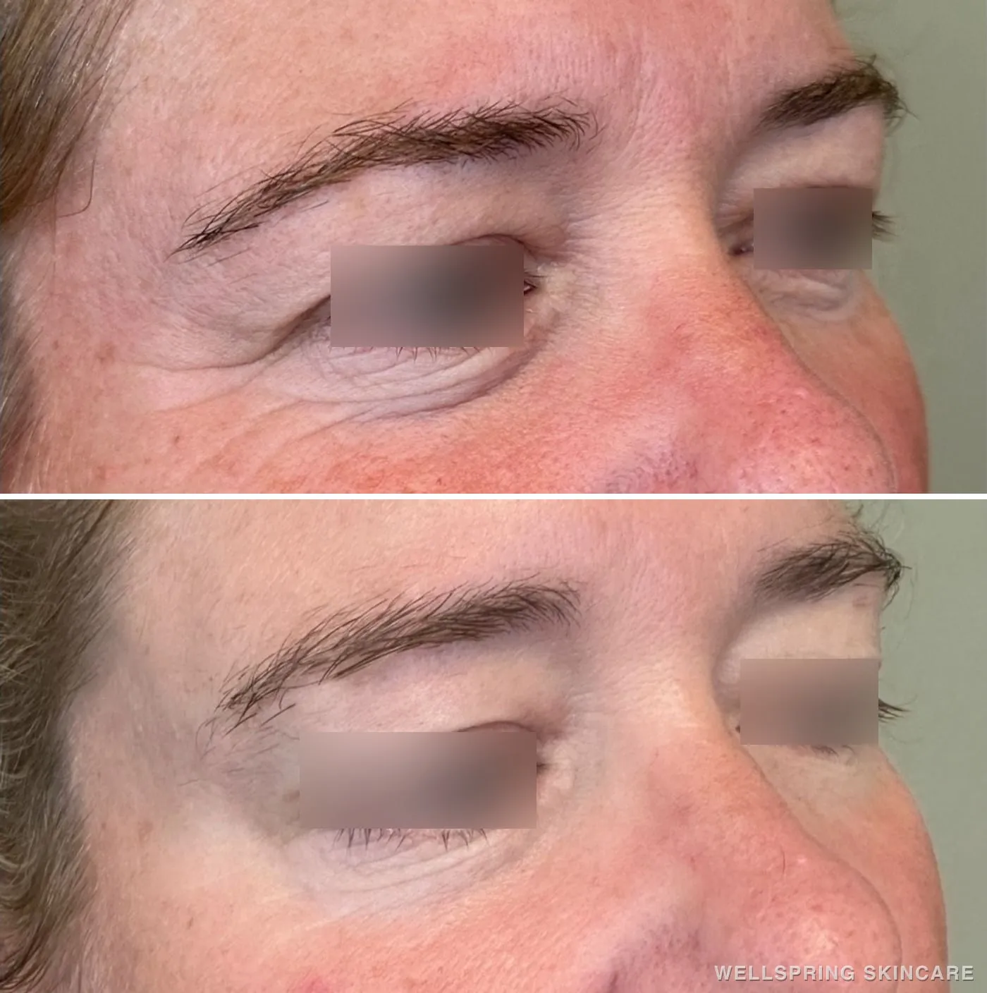 Before and after: Crow's feet wrinkles softened with Botox