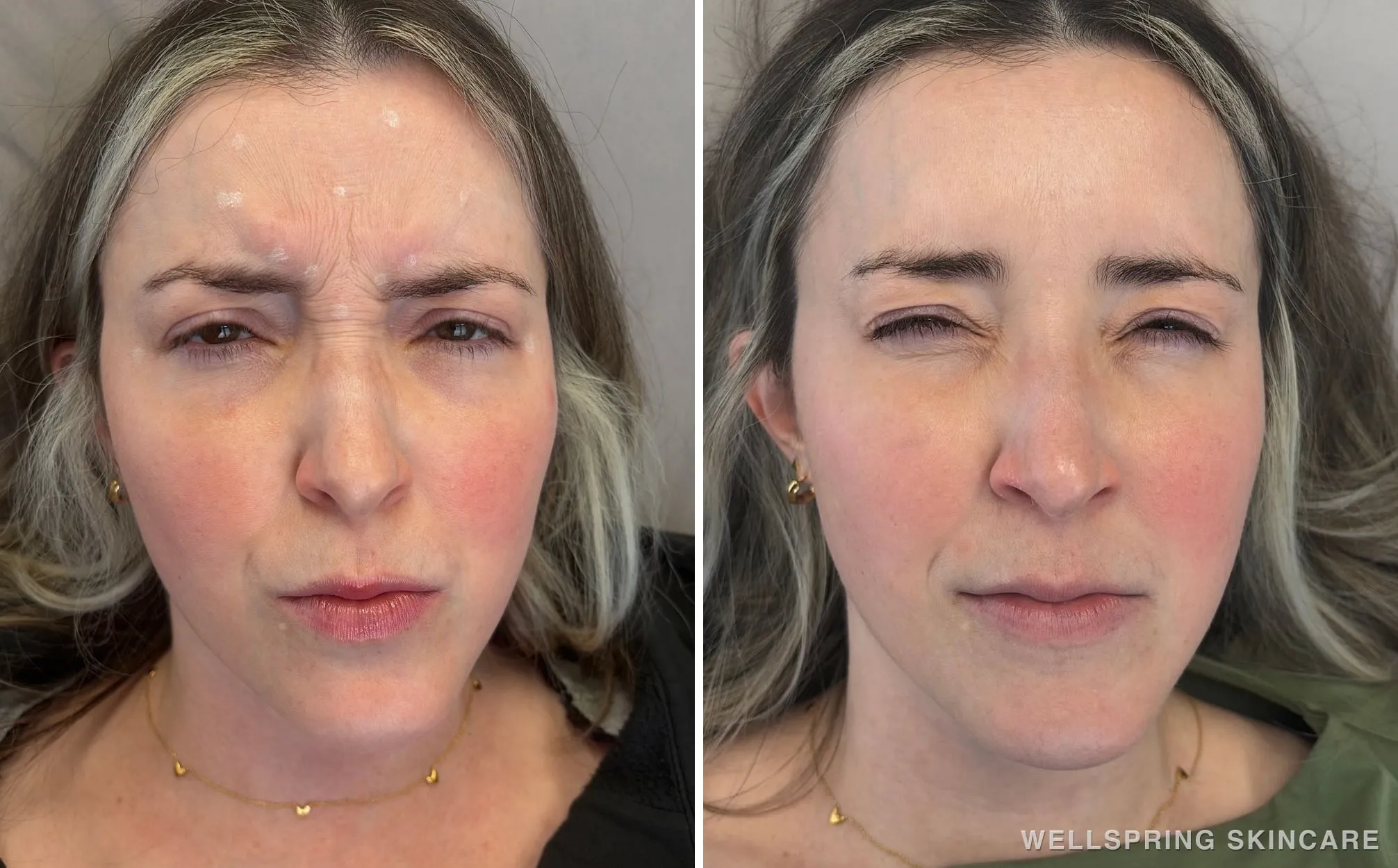 Before and after: Frown & forehead wrinkles treated with Botox