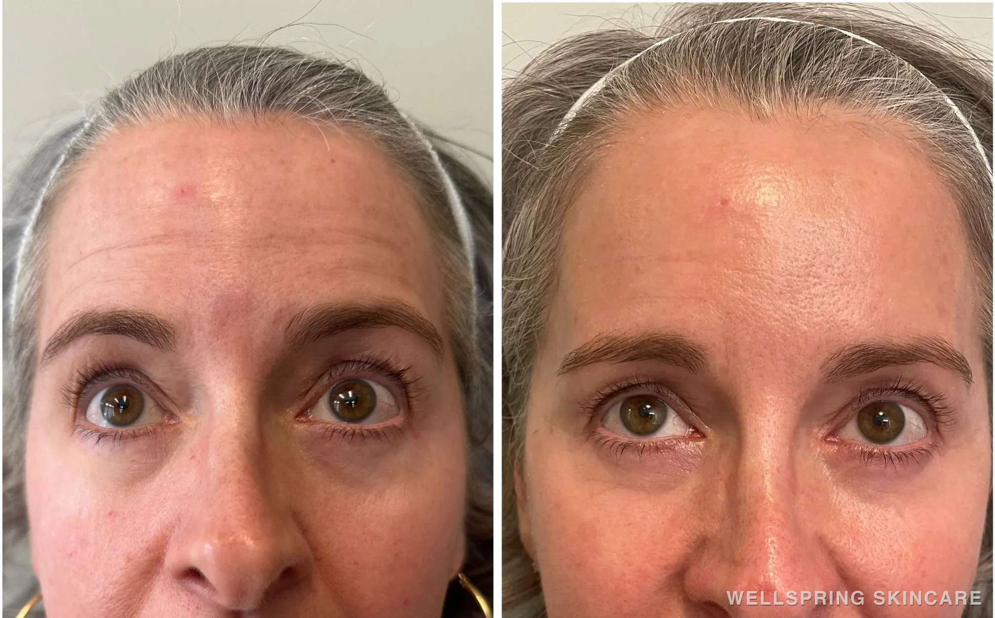 Before and after: Forehead wrinkles treated with Botox