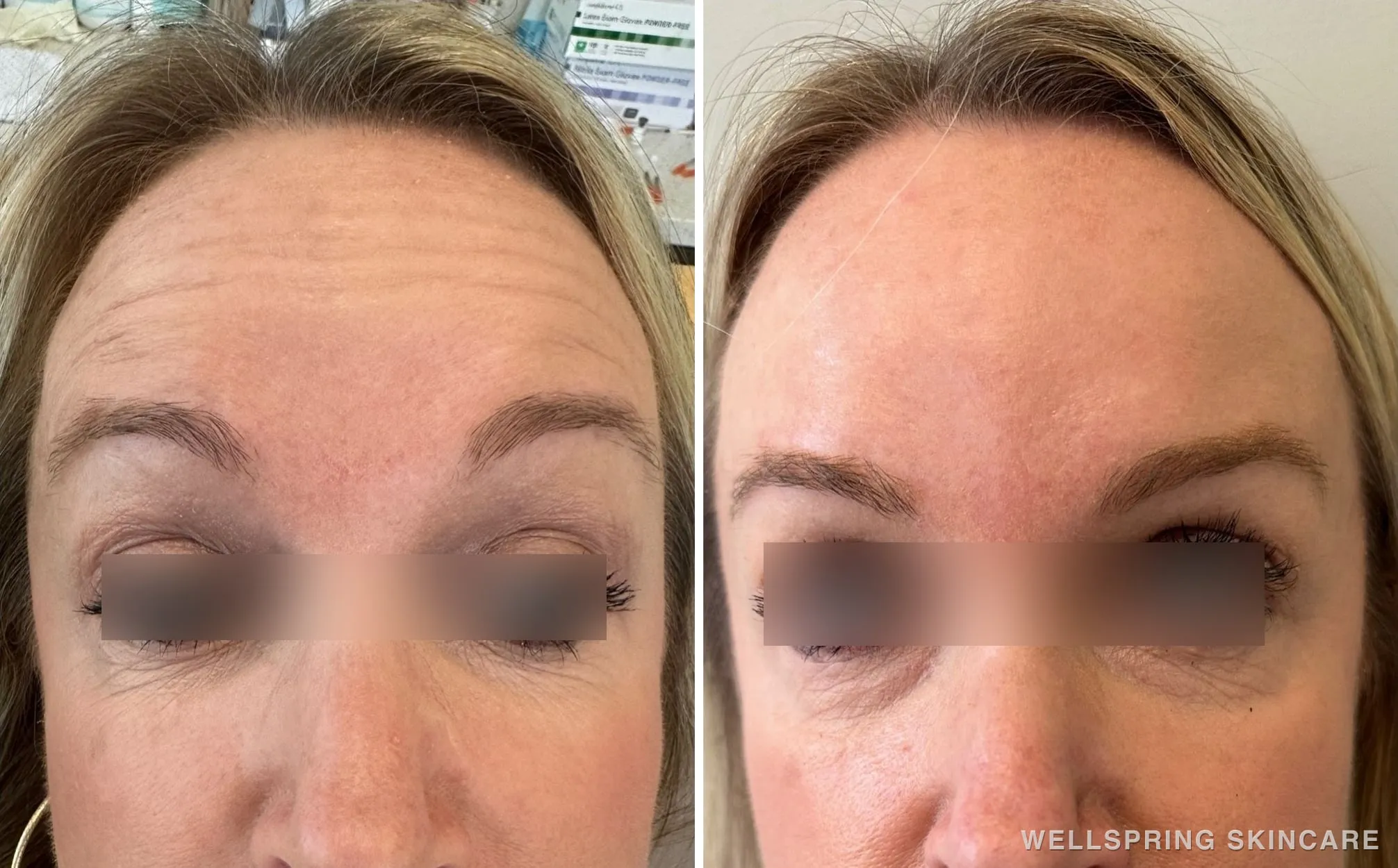 Before and after: Forehead lines treated with Botox