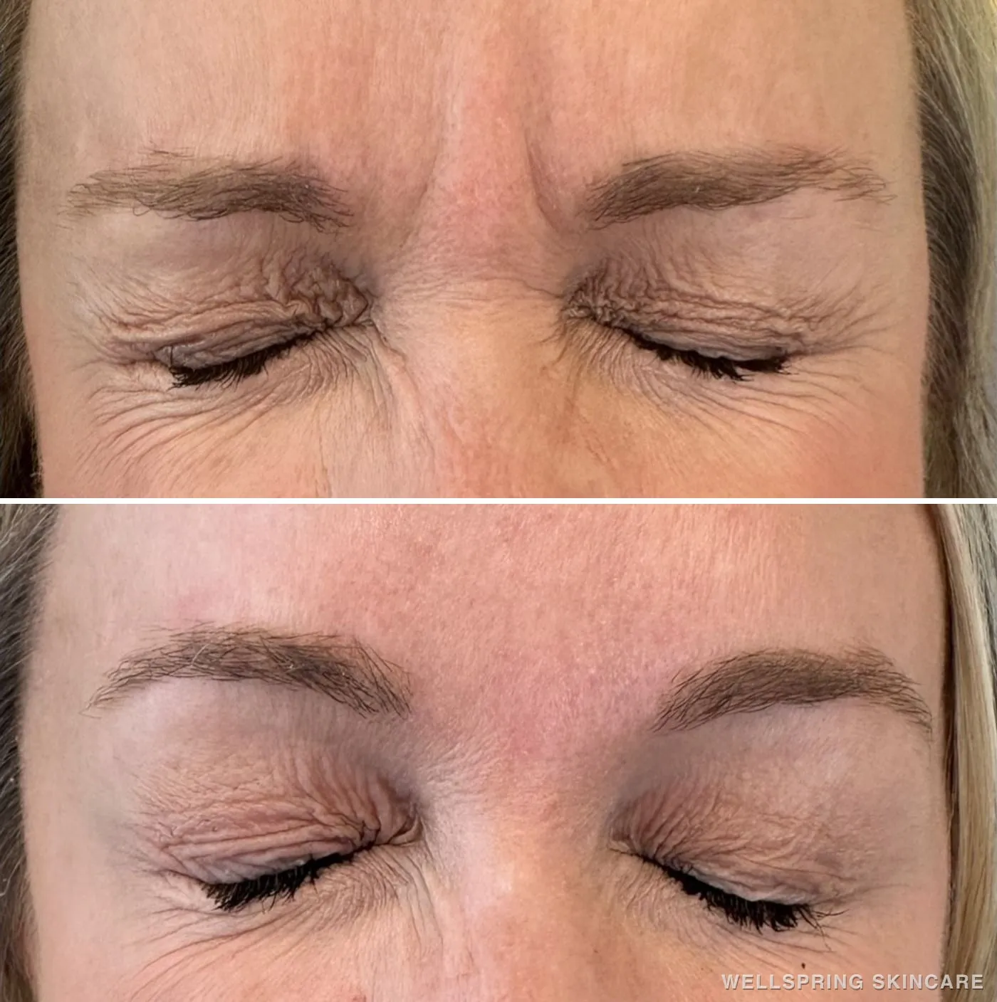 Before and after: Frown lines (the 11s) treated with Botox