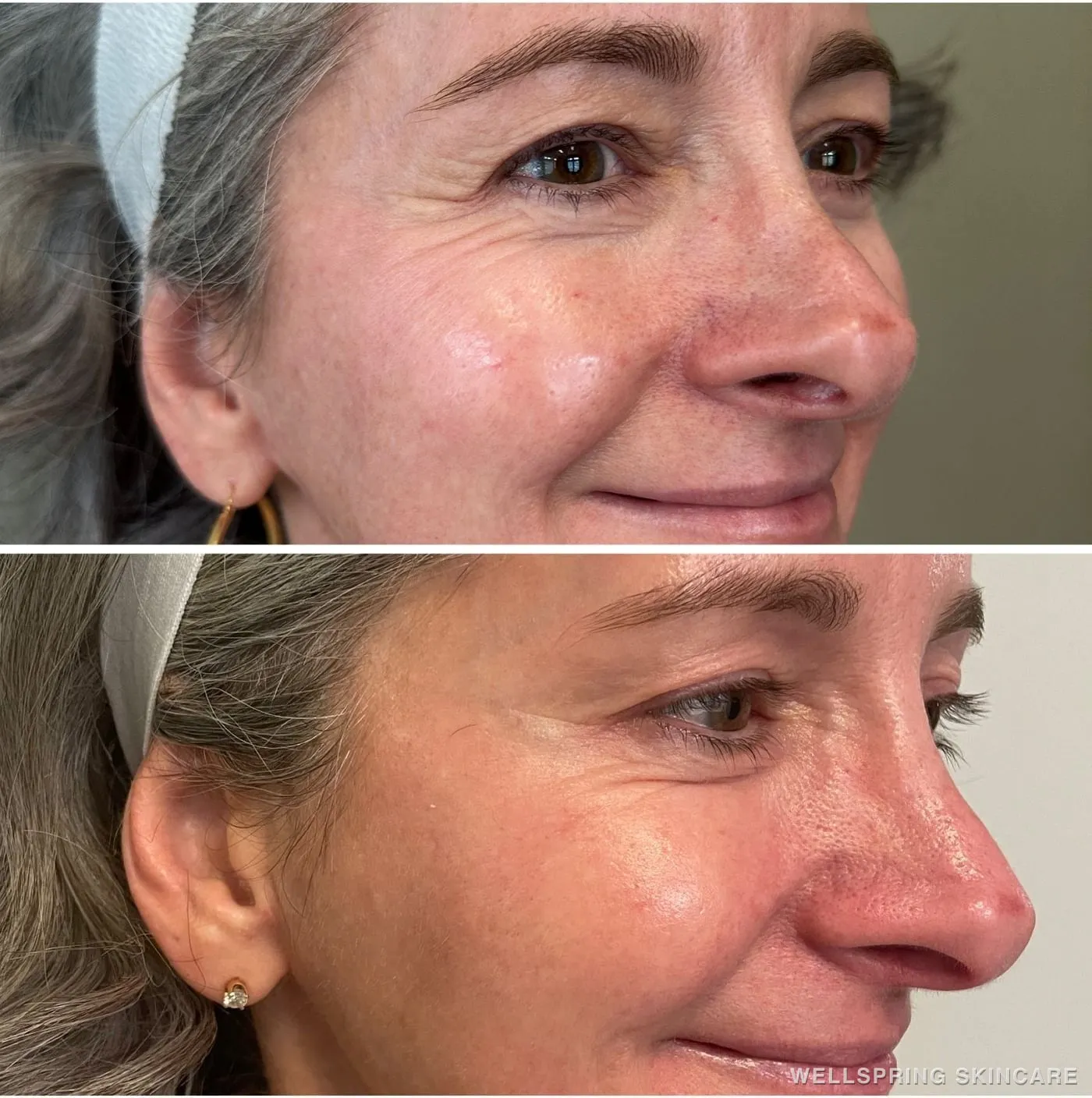 Before and after: Crow's feet & tired-looking eyes treated with Botox