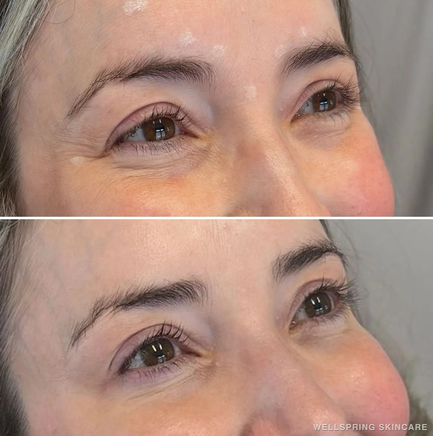 Before and after: Crow's feet & under-eye area treated with Botox