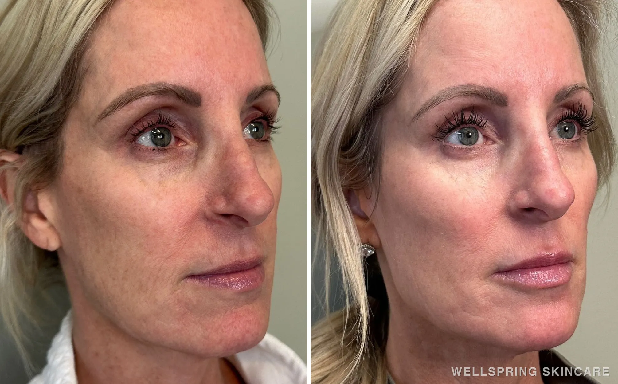 Before and after: Cheeks, smile lines & lips treated with dermal filler