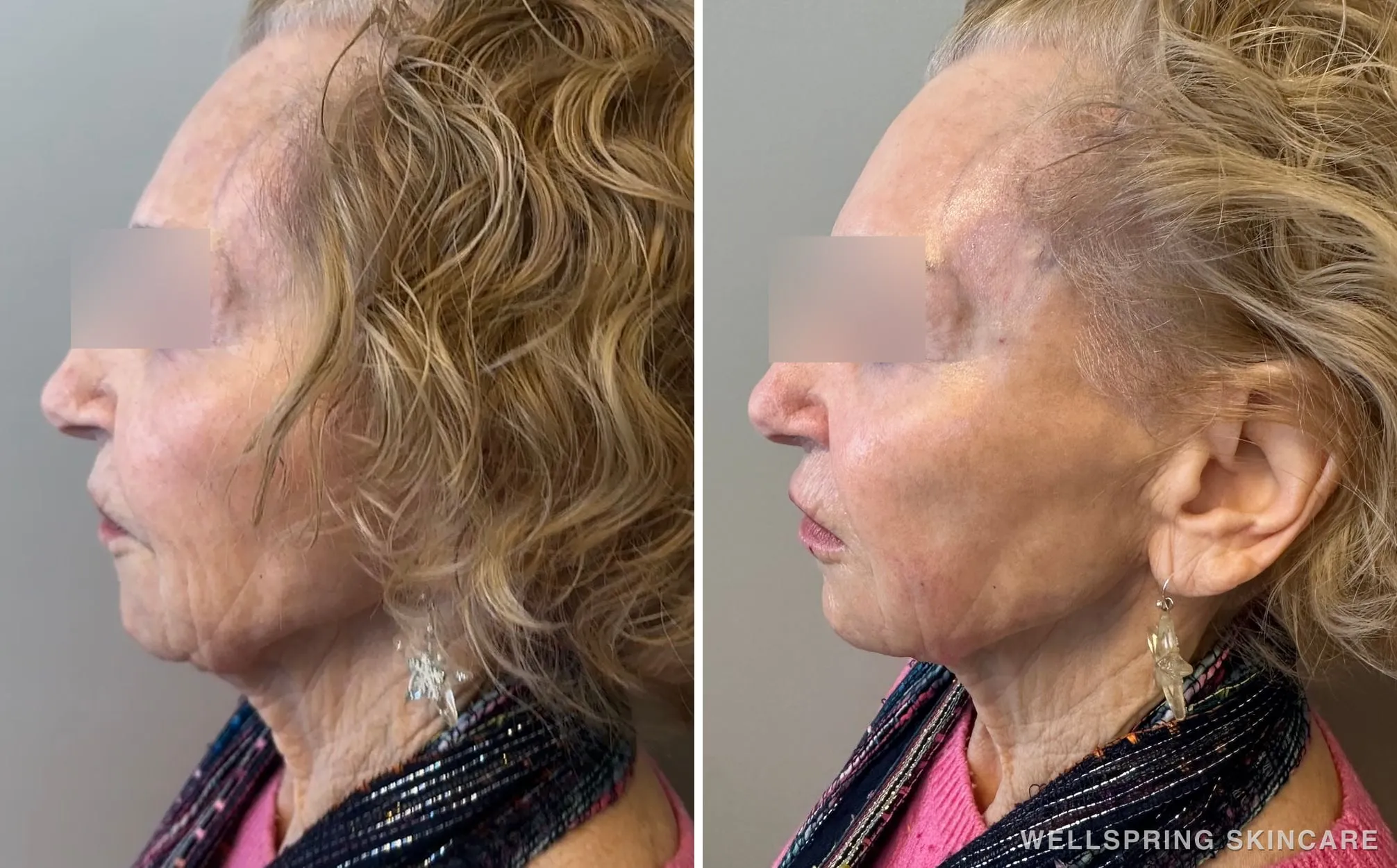 Before and after: Full face dermal filler for cheeks & jawline
