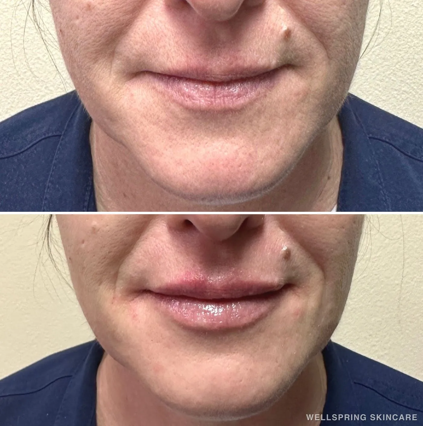 Before and after: Lip filler for fuller lips
