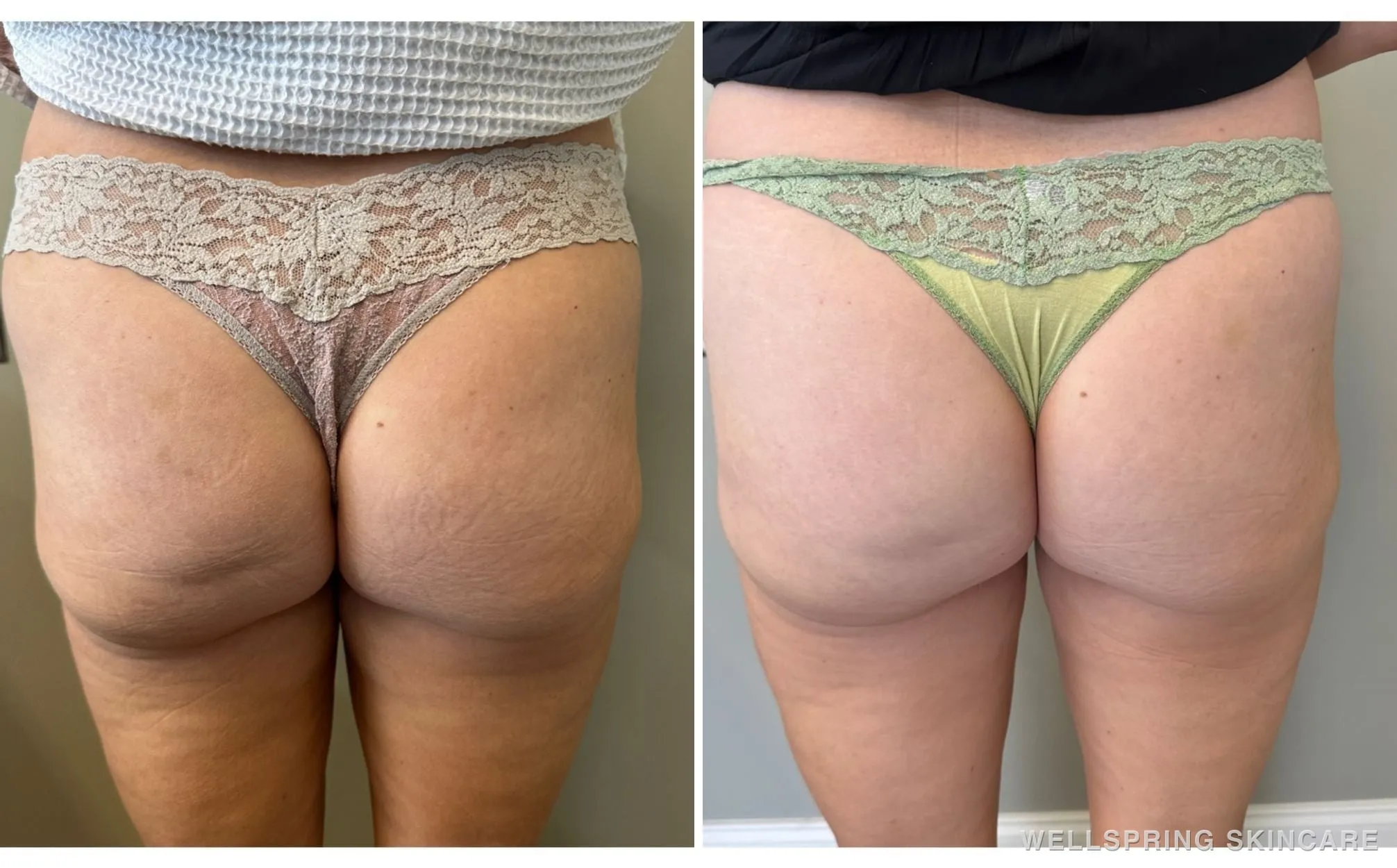 Before and after: Non-surgical glute augmentation with dermal filler