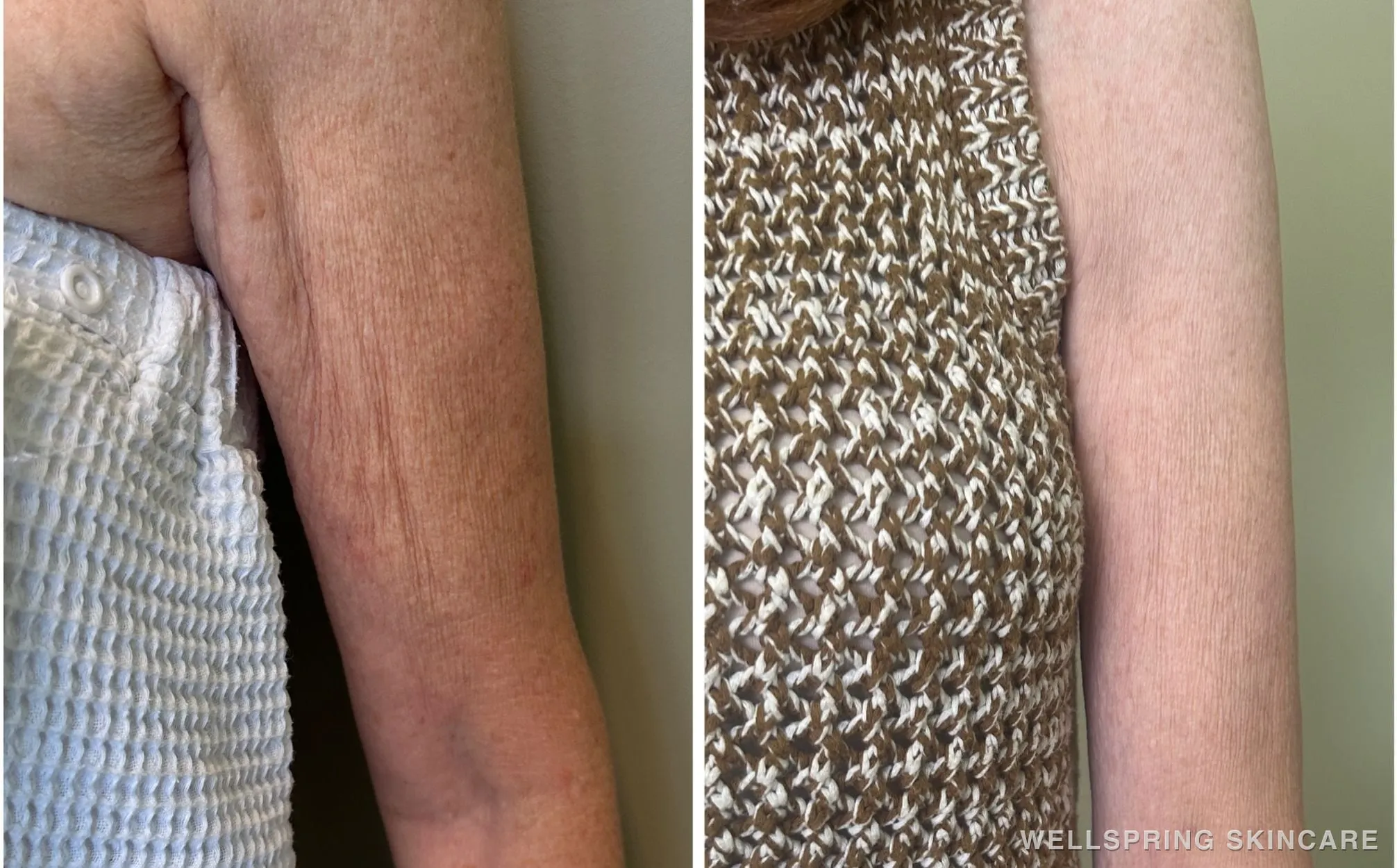 Before and after: Crepey arm skin treated with dermal filler