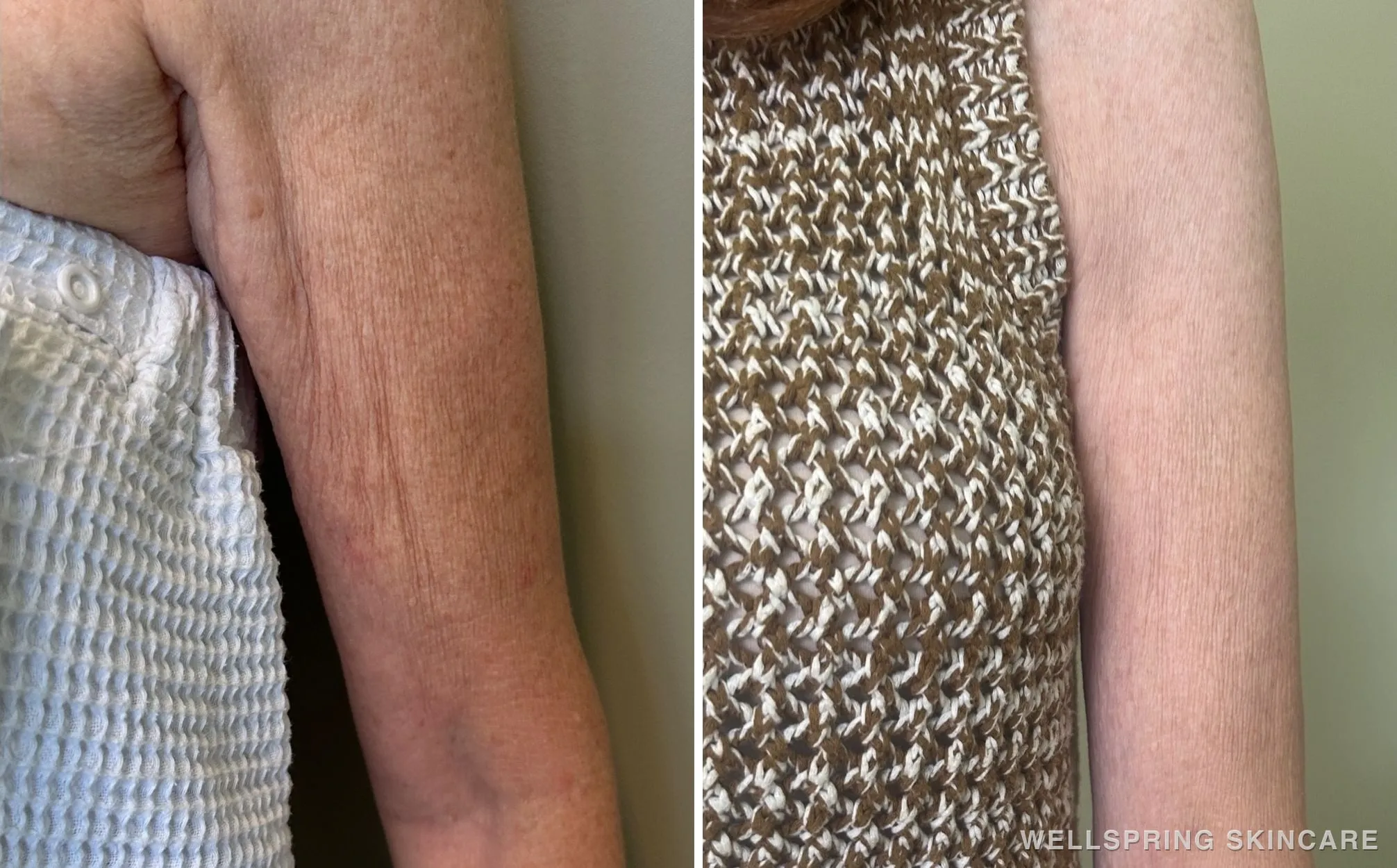Before and after: Crepey arm skin treated with dermal filler