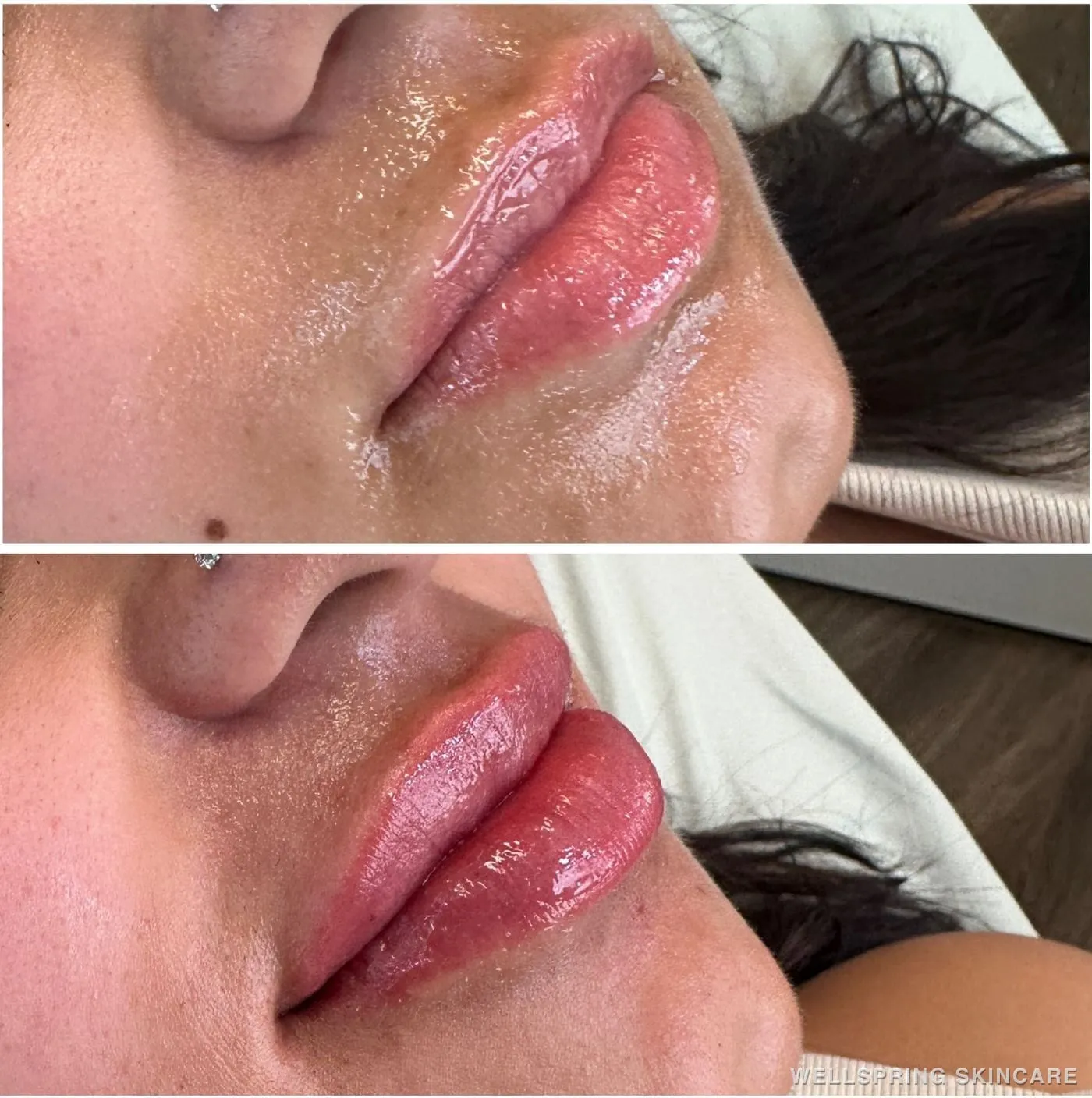 Before and after: Fuller lips with lip filler