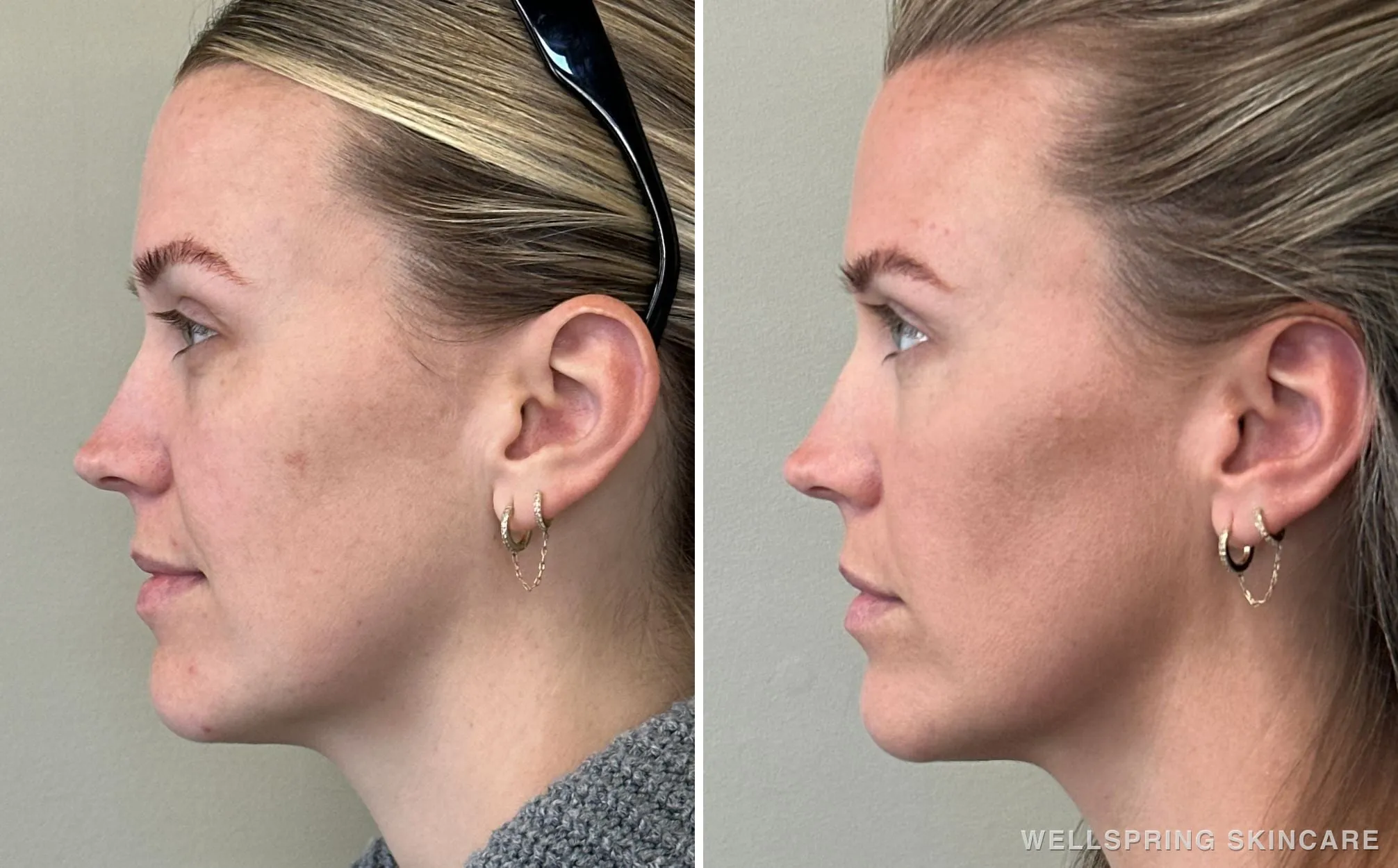 Before and after: Jawline contour with biostimulatory filler