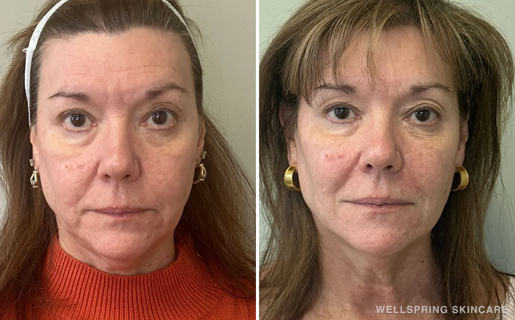 Before and after: Jowls & sagging skin treated with dermal filler
