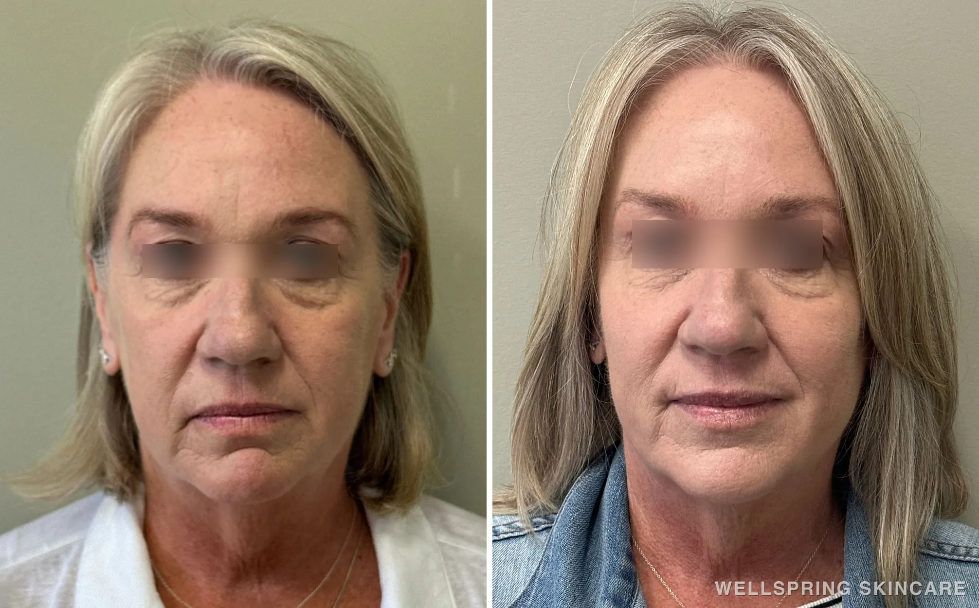 Before and after: Full face dermal filler for jowls & sagging skin