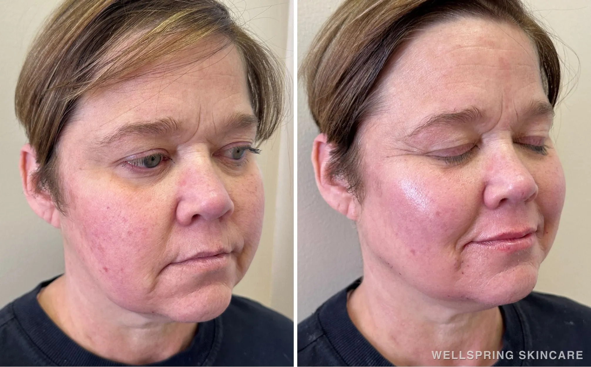 Before and after: Marionette & smile lines treated with dermal filler