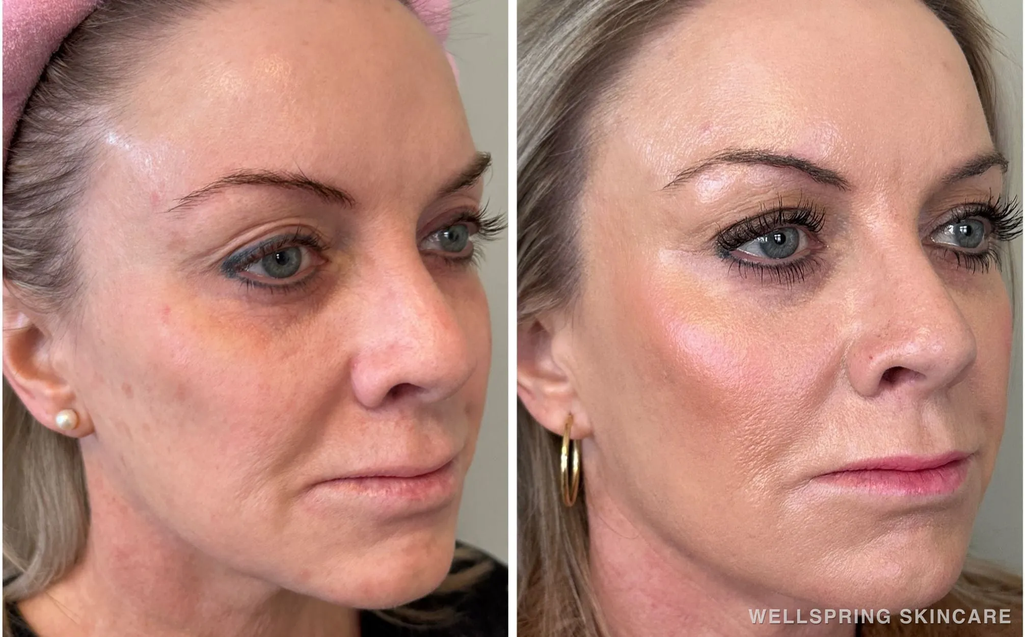 Before and after: Dull & dry skin treated with Halo
