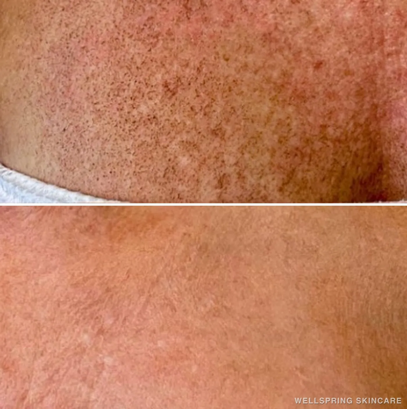 Before and after: Sun damage & brown spots treated with IPL