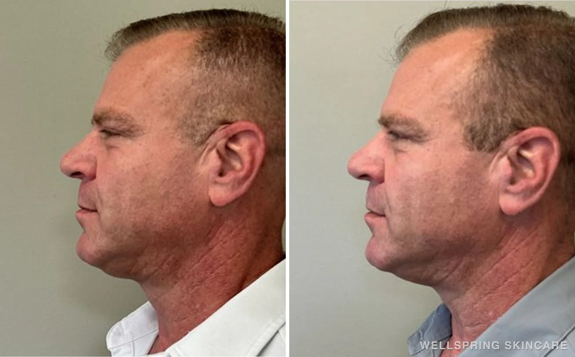 Before and after: Double chin treated with Kybella