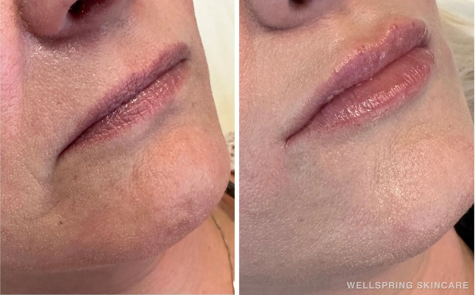 Before and after: Lips treated with lip filler