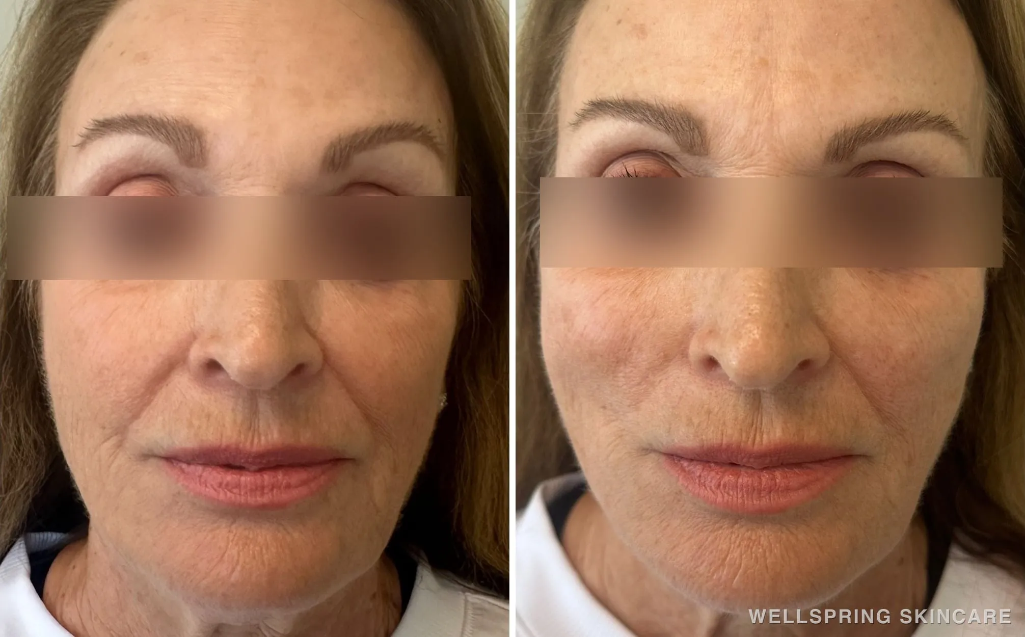 Before and after: Jowls & sagging skin treated with a PDO thread lift