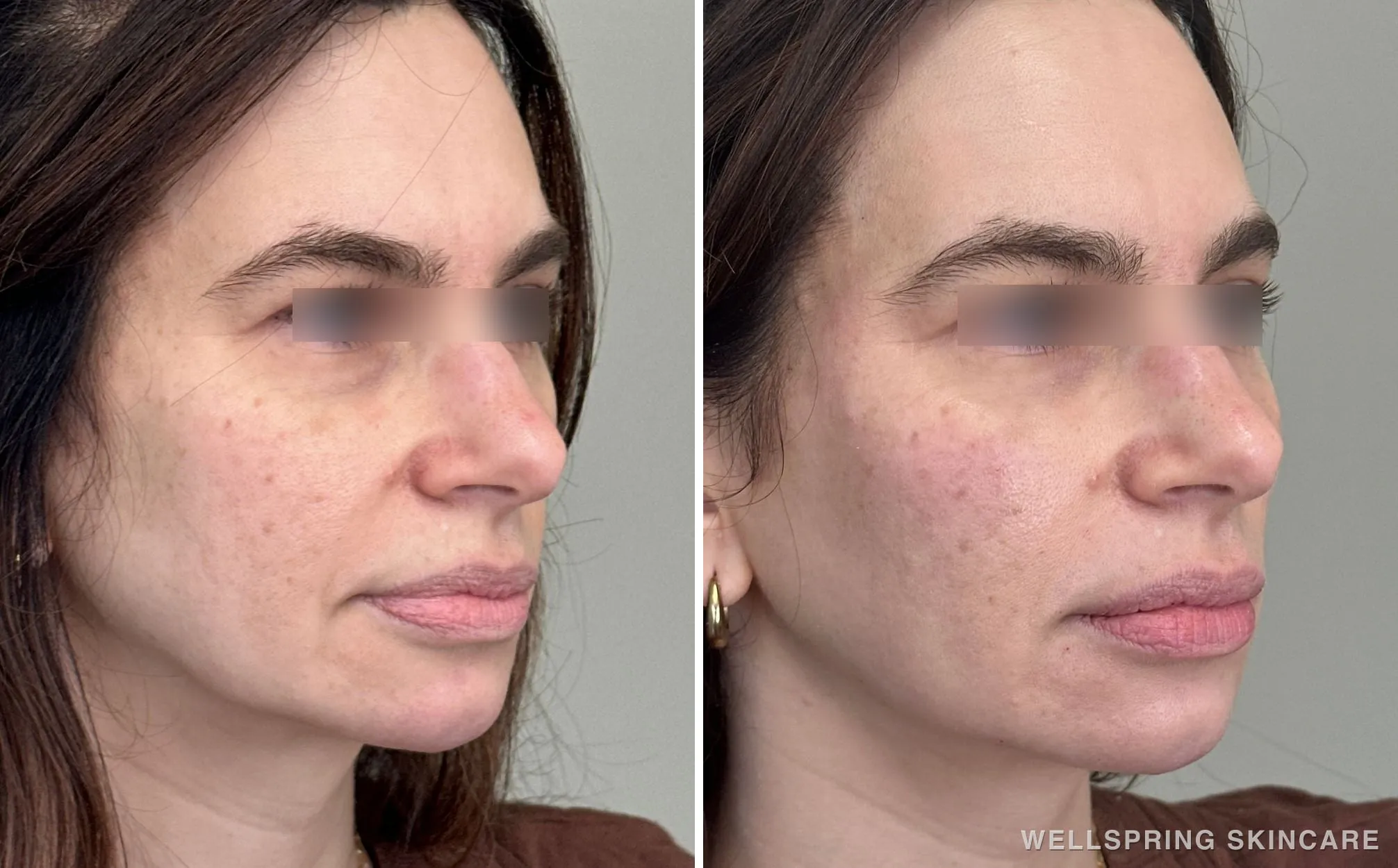 Before and after: Under-eye hollows treated with PRF